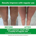 TESMED Manual Cellulite Massager Made in Italy with Converging Roller Technology